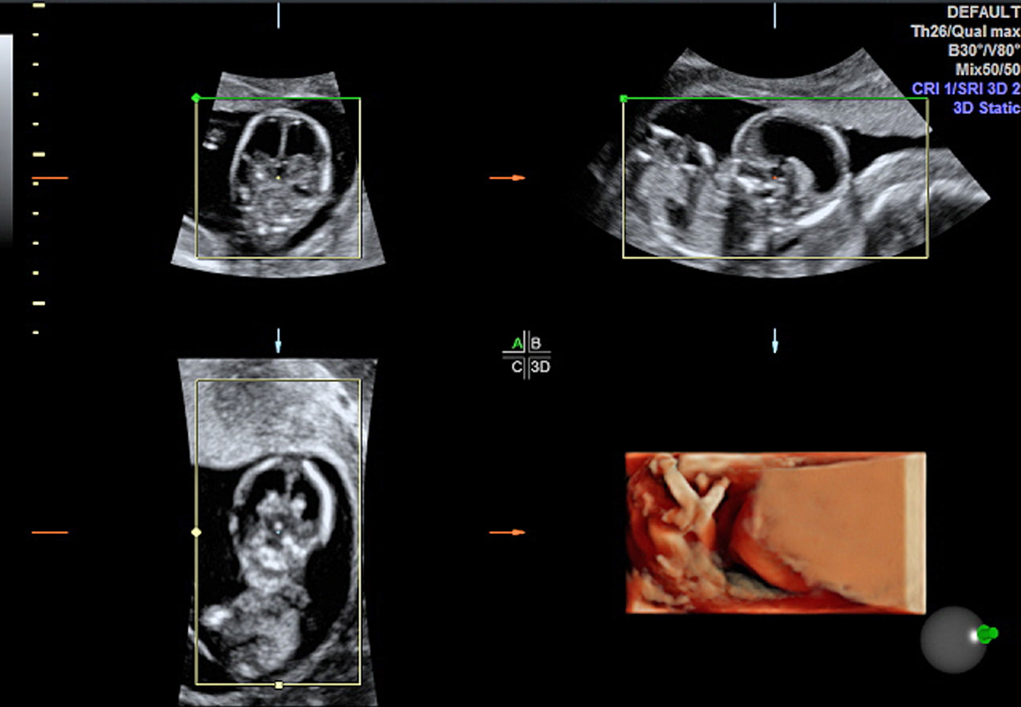 Oligohydramnion in the First Half of Pregnancy in the Fetuses with  Congenital Abnormalities: Ultrasound Diagnostics and Obstetric Outcomes -  Voevodin - Annals of the Russian academy of medical sciences