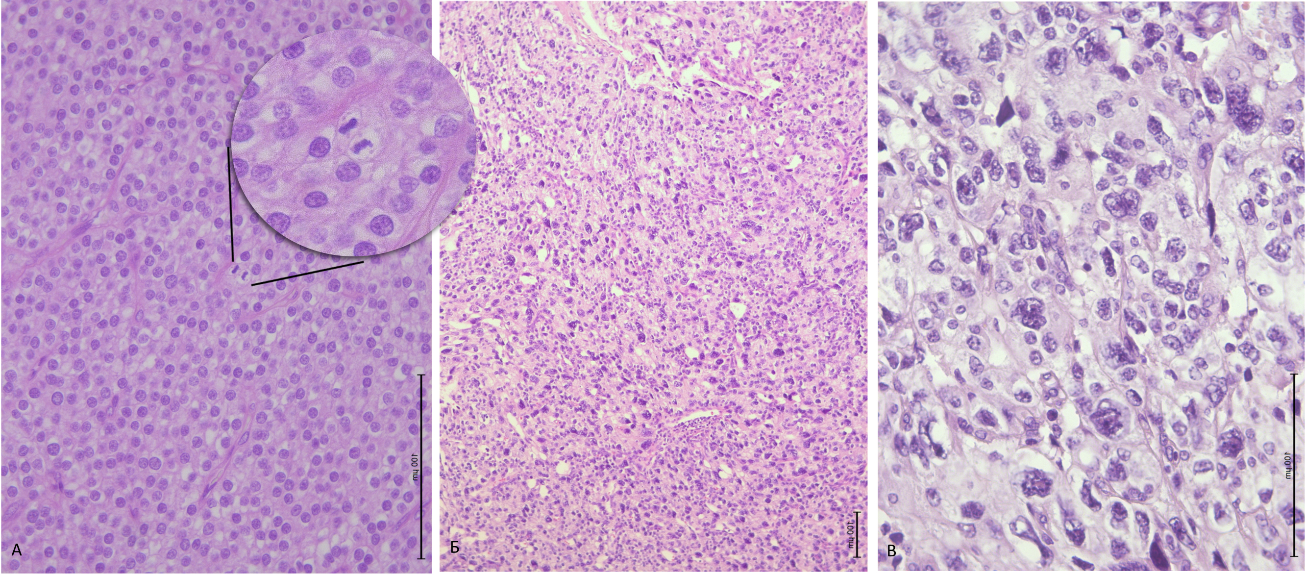 A retrospective study of the clinical and laboratory predictors and  morphological characteristics of the parathyroid carcinoma - Krupinova -  Annals of the Russian academy of medical sciences